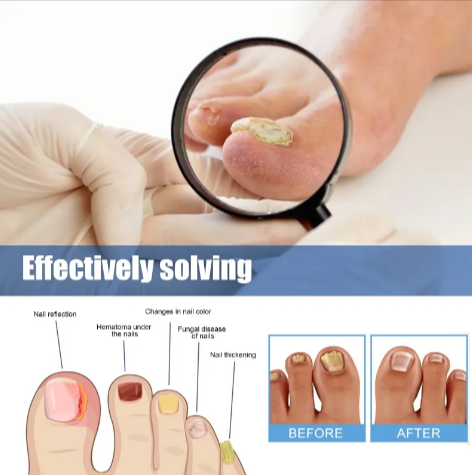 FungiPatch™ | Fungal Nail Patch | Eliminates up to 98% of nail fungus in just 8 days