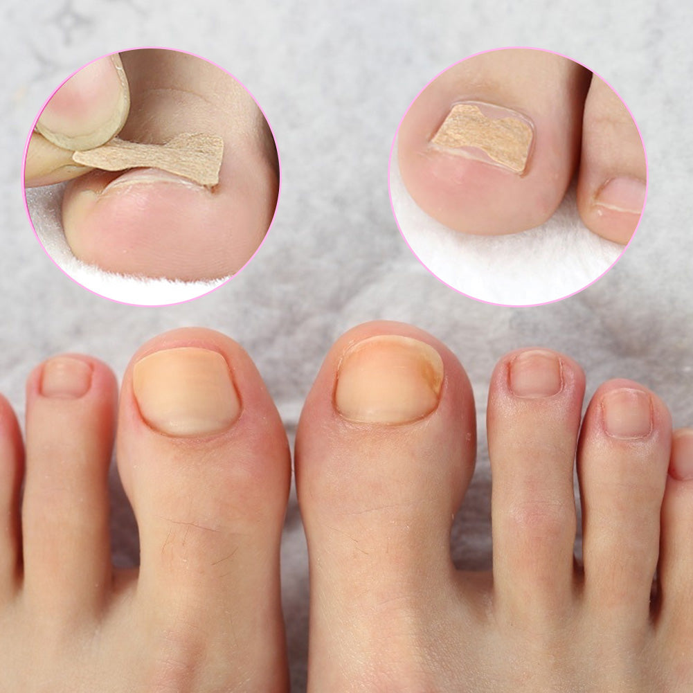 NailFix™ | Ingrown Nail Toenail Corrector